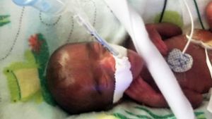 Frühchen Saybie kam in der 23 Schwangerschaftswoche mit nur 245 Gramm auf die Welt. Foto: Uncredited/Sharp HealthCare/AP/d