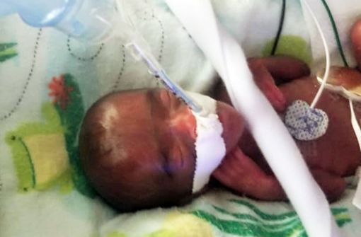 Frühchen Saybie kam in der 23 Schwangerschaftswoche mit nur 245 Gramm auf die Welt. Foto: Uncredited/Sharp HealthCare/AP/d