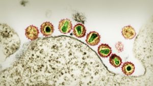 HI-Retroviren unter dem  Elektronenmikroskop: Bei einem  HIV-positiven Patienten sind 34 Monate nach einer  Stammzelltransplantation keine Viren mehr nachweisbar. Foto: R. Gelderblom/RKI/dpa