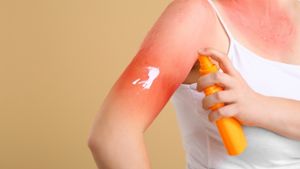 Der Sonnenbrand kann unterschiedliche Gründe haben. Foto: Pixel-Shot / shutterstock.com