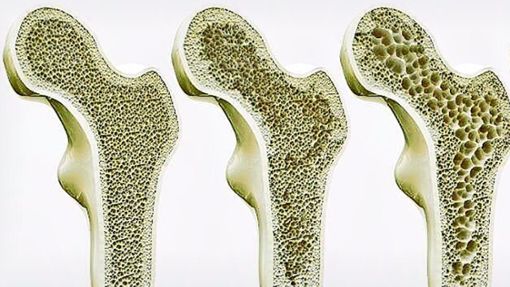 Querschnitt durch einen Knochen: Bei Osteoporose baut sich die Knochensubstanz stärker als üblich ab, der  Knochen wird dadurch brüchig. Foto: /Shutterstock