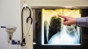 Ein Arzt zeigt am  einen Tuberkulose-Fall anhand eines Röntgenbildes. Foto: dpa