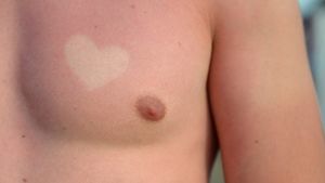 Als Liebesbeweis sind Sonnenbrand-Tattoos eine sehr ungesunde Idee. Foto: dpa-Zentralbild