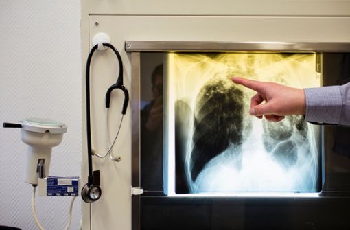 Im Kreis Karlsruhe sorgen Tuberkulose-Fälle für Unruhe. Foto: dpa