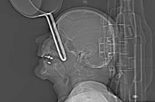 Die Röntgenaufnahme zeigt den in der Augenhöhle steckenden Kochtopfstiel. Foto: Copyright Deutsche Gesellschaft für Mund-, Kiefer- und Gesichtschirurgie
