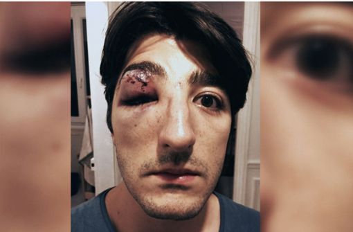 Einer der Protagonisten des Films, Arnaud,  beschließt, ein Foto seines verletzten Gesichts in sozialen Netzwerken zu veröffentlichen – Szene aus „Hass gegen queer“. Foto: WDR/Doclights/Dunja Engelbrecht