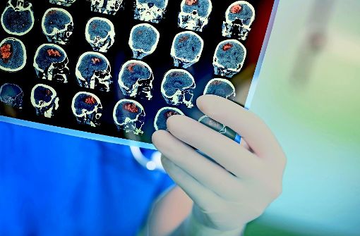 Mithilfe von Hirn-Scans  versuchen Ärzte herauszufinden, wo nach einem Schlaganfall der Blutfluss im Gehirn stockt. Lesen Sie in unserer Bilderstrecke, wie man sich vor einem Schlaganfall schützen kann. Foto: AdobeStock/sudok1