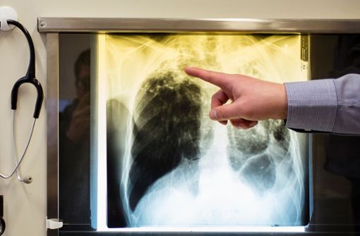 Diagnose: Tuberkulose – in Baden-Württemberg sind auch Strafvollzugsbedienstete betroffen. Foto: dpa
