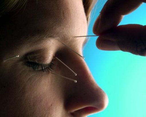Akupunktur kann bei Migräne hilfreich sein Foto: dpa