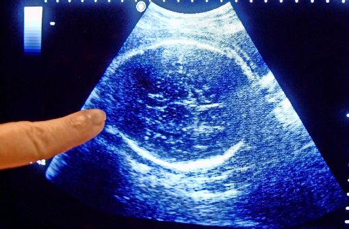 Das Ultraschallbild in einer Artpraxis zeigt  ein ungeborenes Kind Foto: dpa