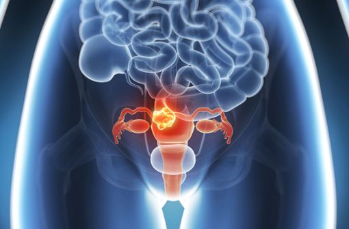 Die Behandlung ist davon abhängig, wo das Myom in der Gebärmutter sitzt. Foto: SciePro - stock.adobe.com