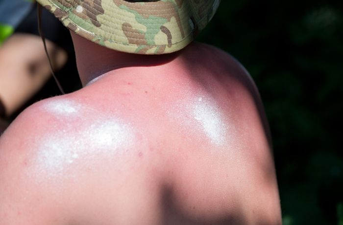 Sonnenbrand im Frühsommer: Unterschätzte Gefahr Sonnenbrand