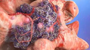 Zell-Mutation und -Entartung: Eine Krebszelle (dunkelviolett) breitet sich in gesundem Gewebe aus und befällt dieses. Foto: Imago/Pond5 Images