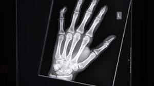 Röntgenaufnahmen von der Hand sollen dabei helfen, das Alter eines Menschen festzustellen. Foto: dpa