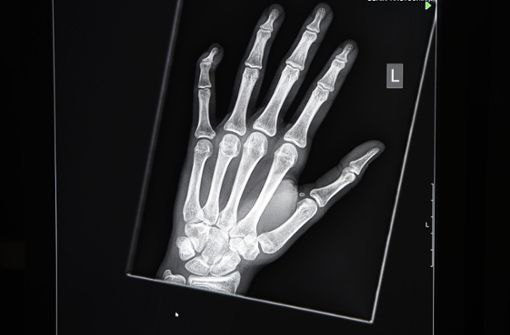 Röntgenaufnahmen von der Hand sollen dabei helfen, das Alter eines Menschen festzustellen. Foto: dpa